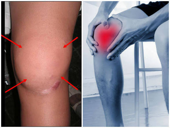 Knee swelling